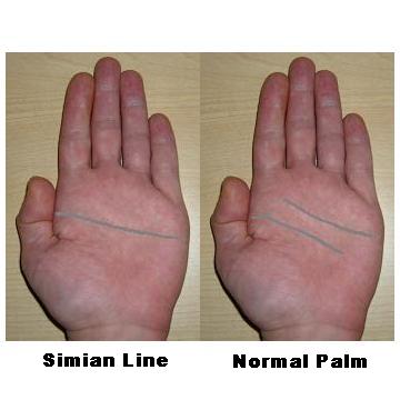 Normal palm and hand with simian line